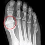 Big toe joint arthritis and ball of the foot pain.