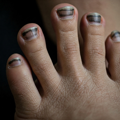 very long toenails