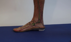 custom orthotics flat foot posterior tibialis