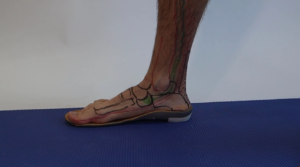 Posterior tibialist tendon flat foot changes