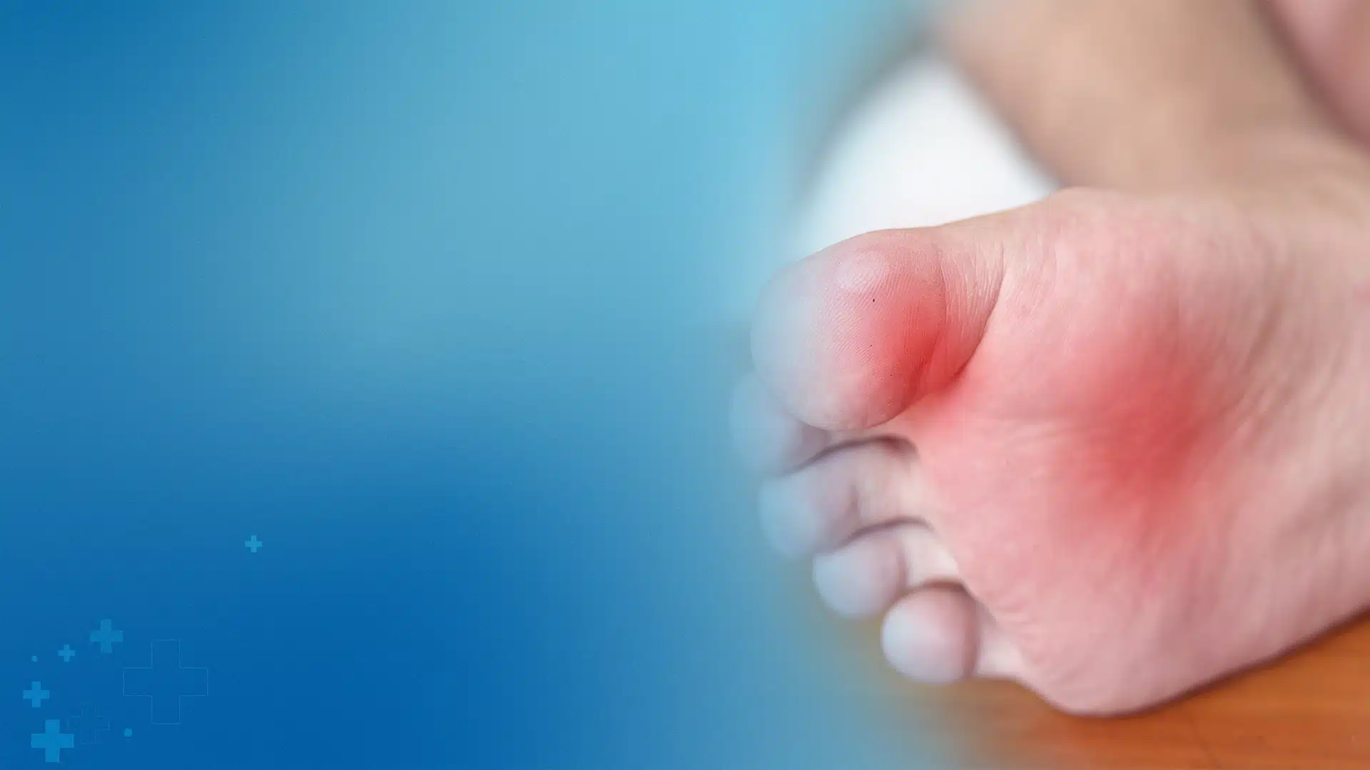 High Ankle Sprain: Why It Takes Longer to Heal Than a Regular Sprain 2 Close-up of a human foot with a highlighted red, inflamed area under the big toe indicating sesamoiditis, a condition tr