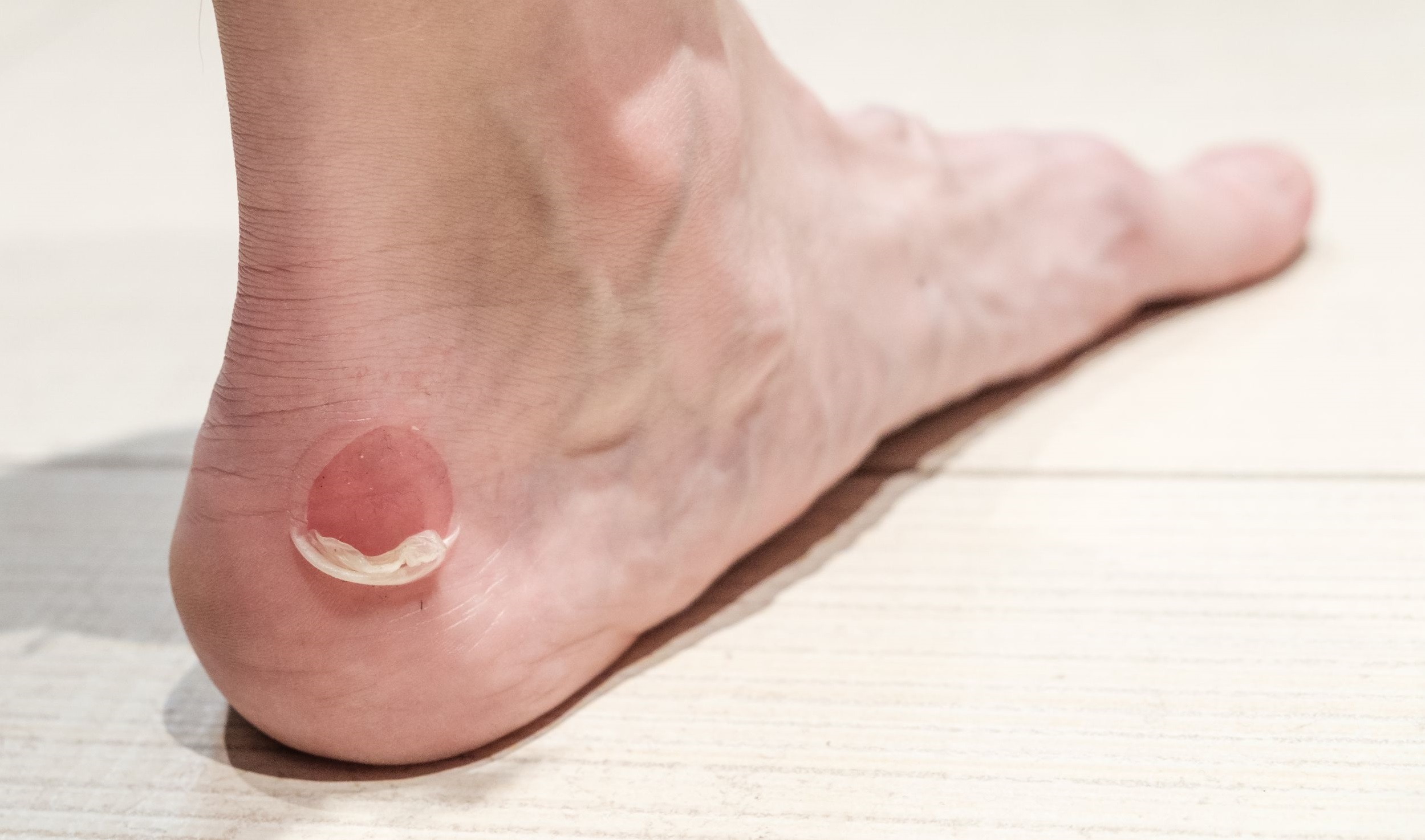 Painful And Sore Blisters On The Foot And Toe Blood Blister Treatment