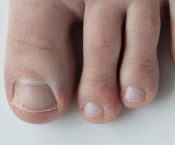 black spot under toenail 1