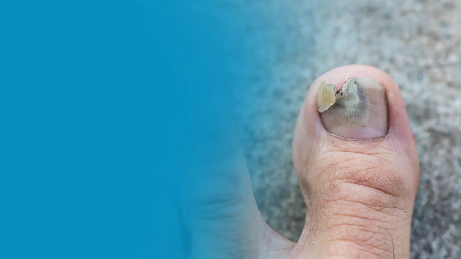 black spot under toenails