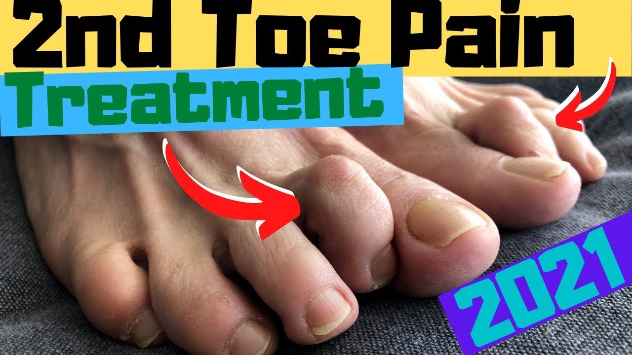 capsulitis of the second toe treatment