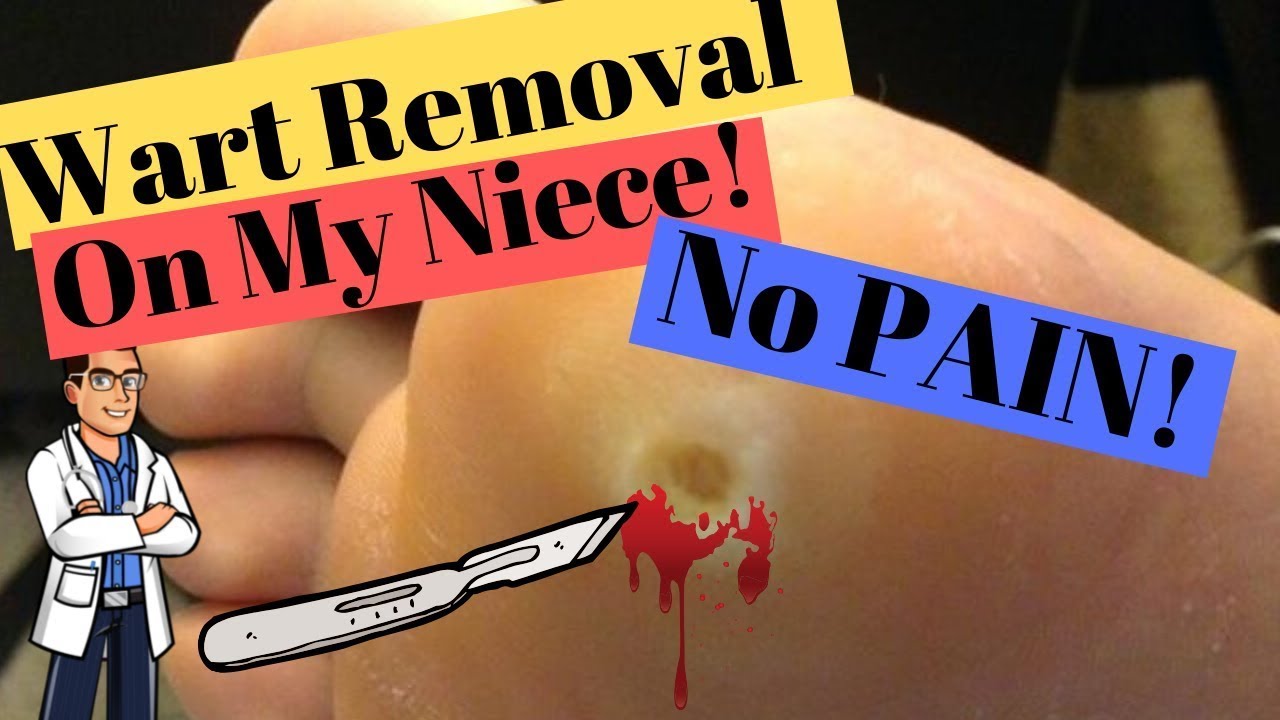foot wart verruca pain 1