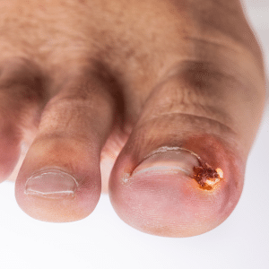 ingrown toenail with pus