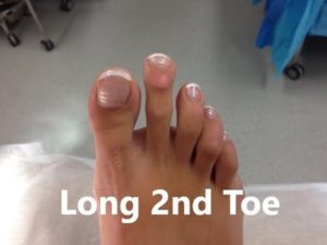 Long 2nd toe, toenail damage and injury