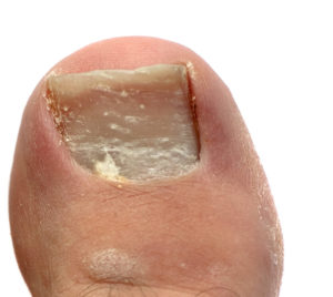 Keratin granulations white patches on big toenail