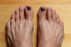 Mole Under Toenail 2026: When to Worry | Podiatrist 3 Toe Nail Coming Off the Nail Bed: Causes & Best Home Treatment 2020!