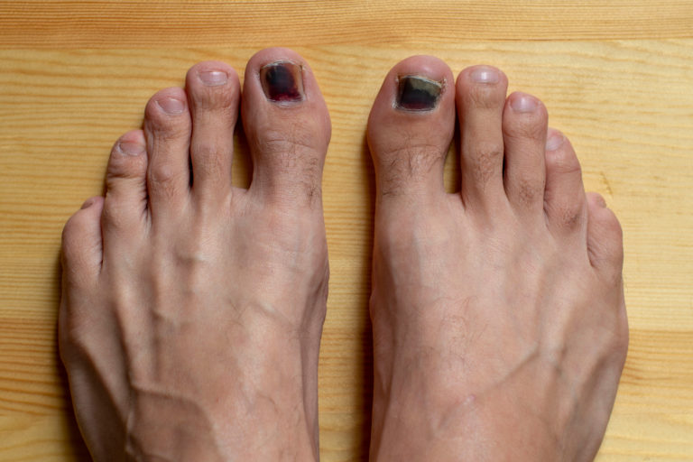 a kezelés foot nail fest)