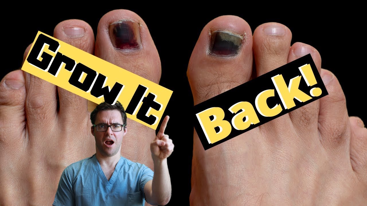 toe nail coming off the nail bed this is what to do