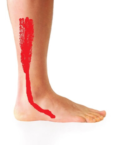 Peroneuslongustendinitis 2 - Balance Foot & Ankle