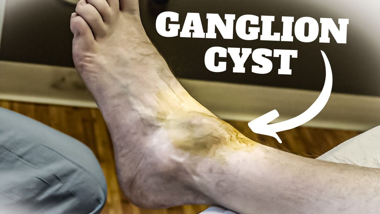 ganglion cyst foot surgery recovery time