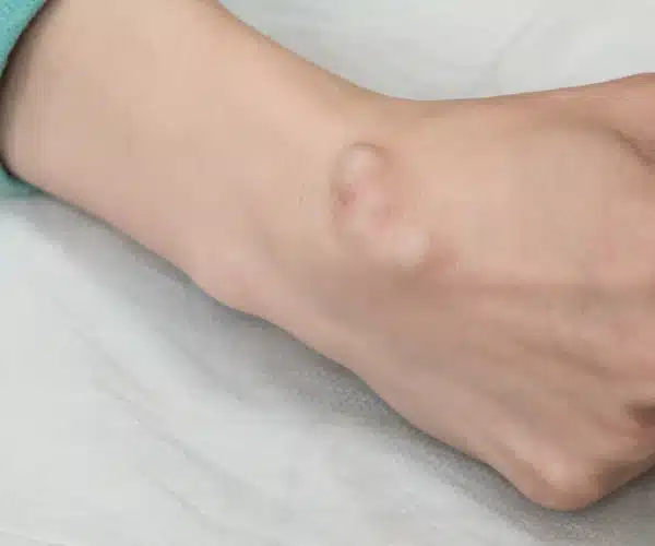 ganglion cyst removal