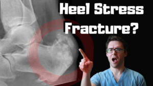 Calcaneal stress fracture Heel stress fracture treatment