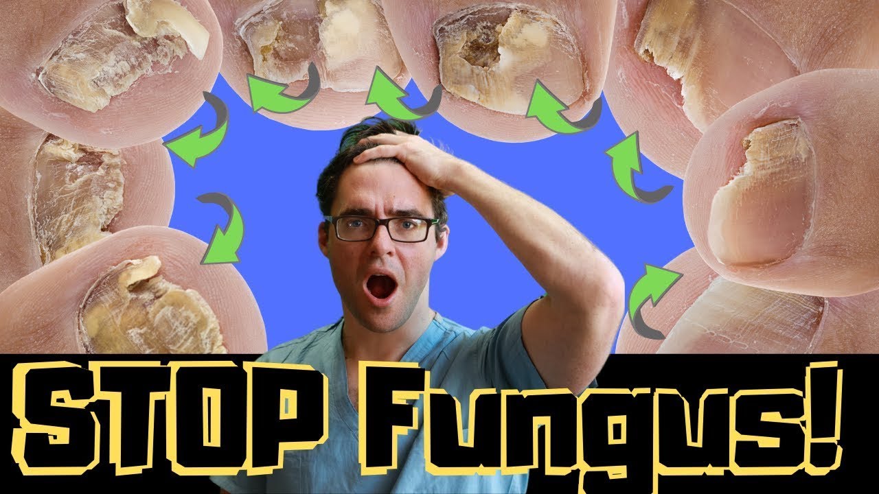 how to fix severe toenail fungus 1
