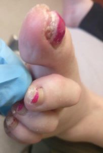 Keratin Granulations or Nail Fungus? The SECRET To Fix It! 2 keratin granulations