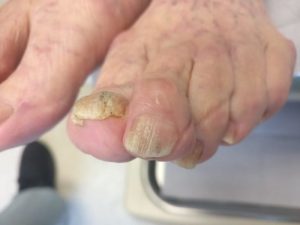 Keratin Granulations or Nail Fungus? The SECRET To Fix It! 15 keratin granulations cure