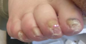 Keratin Granulations or Nail Fungus? The SECRET To Fix It! 3 keratin granulations treatment