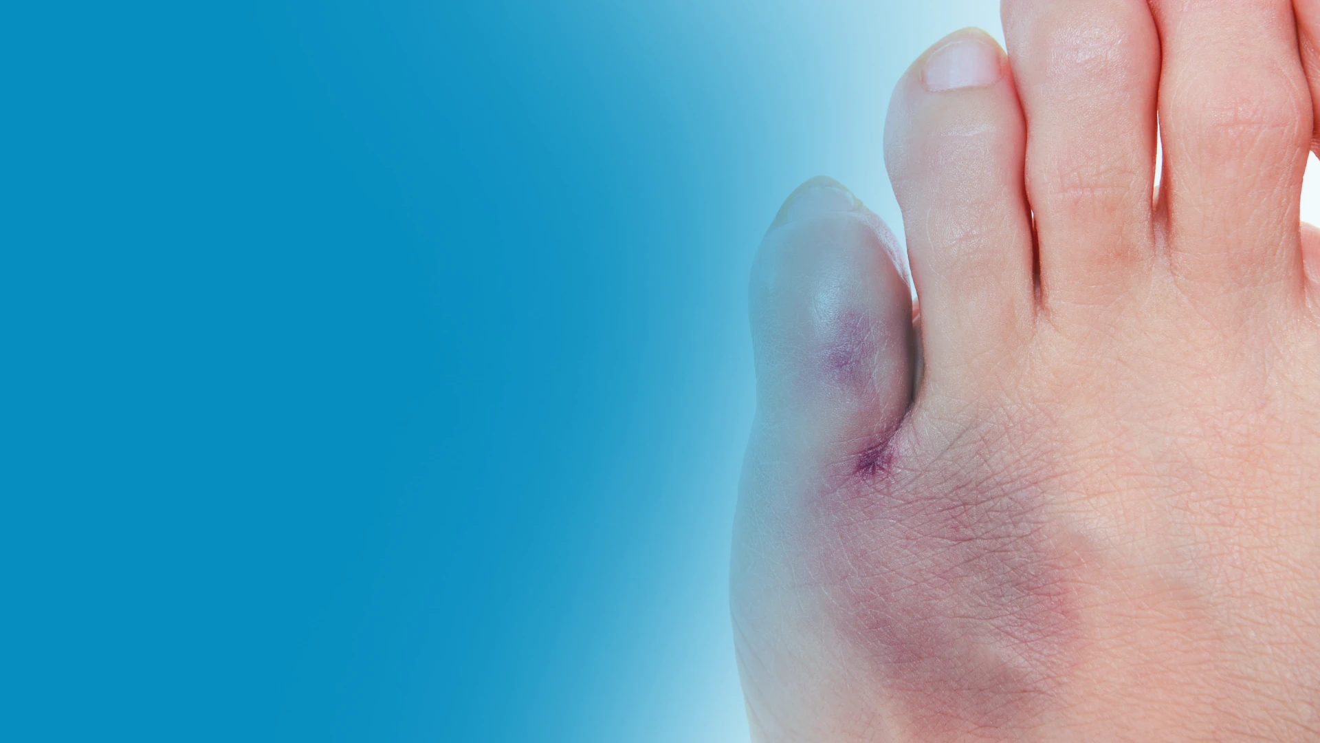 Swollen little toe pain+ with bruising visible.