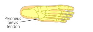 Peroneus Brevis Tendon Insertion