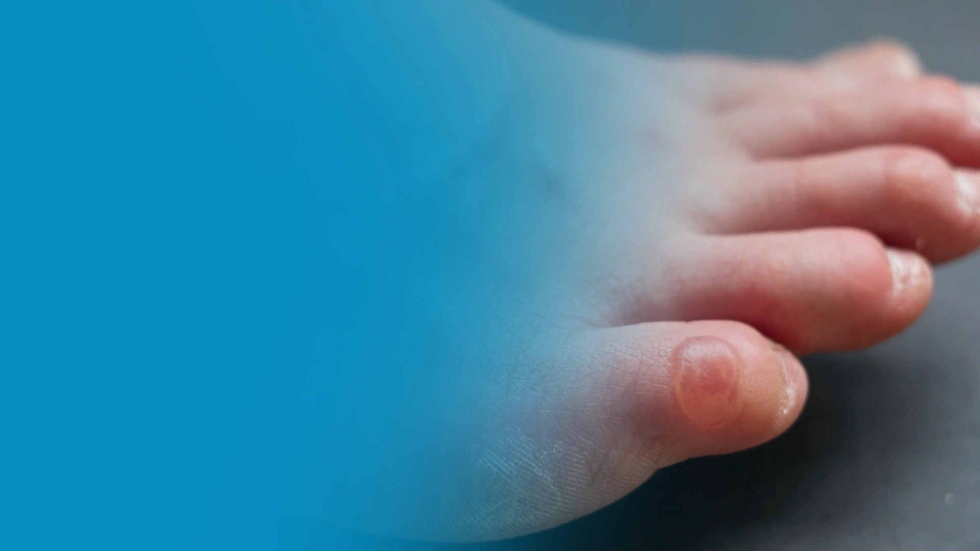 Pinky Toe Pain | Balance Foot Ankle