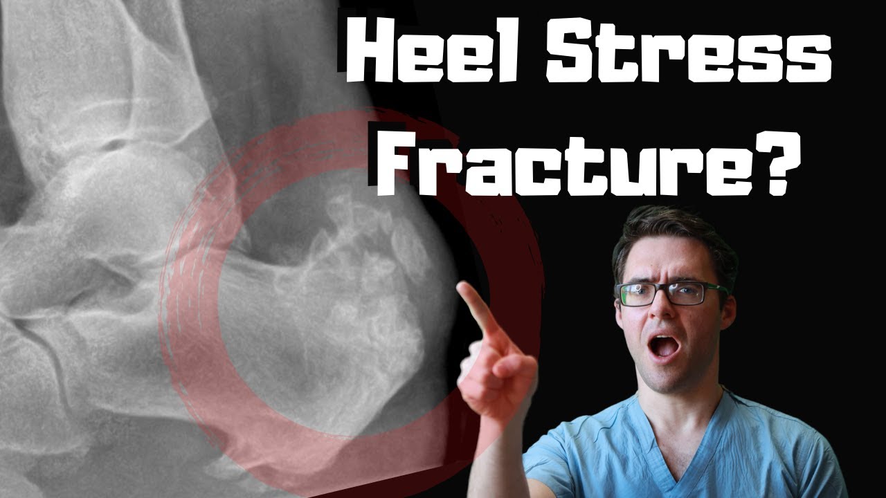 stress fracture of the calcaneus