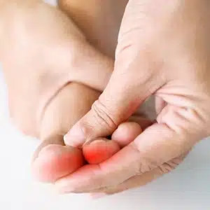 Second Toe Pain due to a Hammer Toe 50 why choose us second toe pain due to a hammer toe