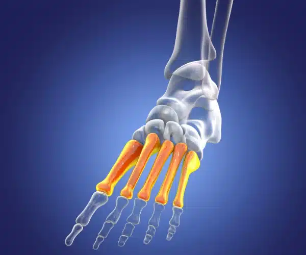 2nd metatarsal of the foot syndrome 1