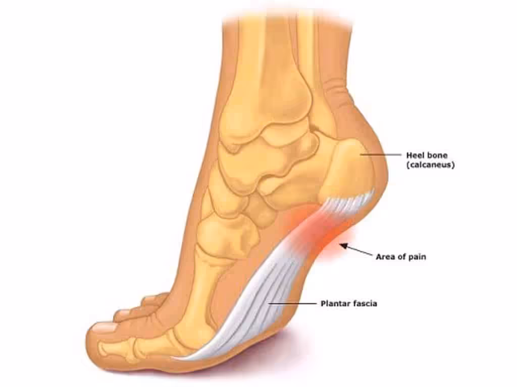 Pain in foot arch and heel