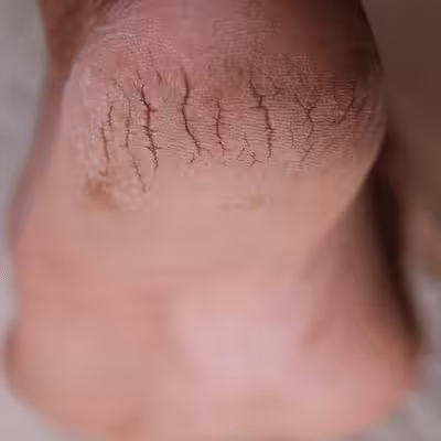 Dry Cracked Feet 1 - Balance Foot & Ankle