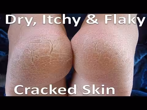 Dry Cracked Feet Or Heel - Balance Foot & Ankle
