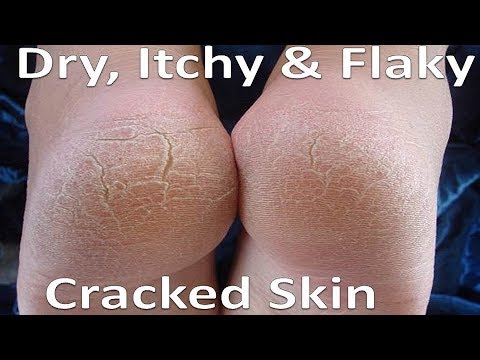 dry cracked feet with cuts, dry cracked feet fungus