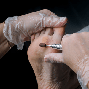 corn on feet removal