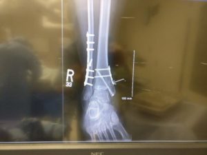 Ankle Fracture with hardware and fixation.