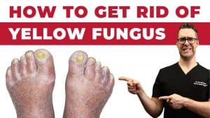 Psoriasis Under The Toenails | Balance Foot & Ankle