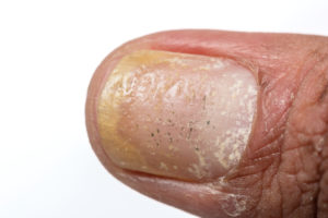 Psoriasis under the toenail Home Treatment