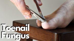 Toenail Jam Under the Toenail Treatment