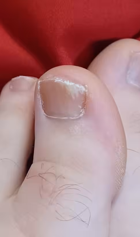 White Patches On Toenails