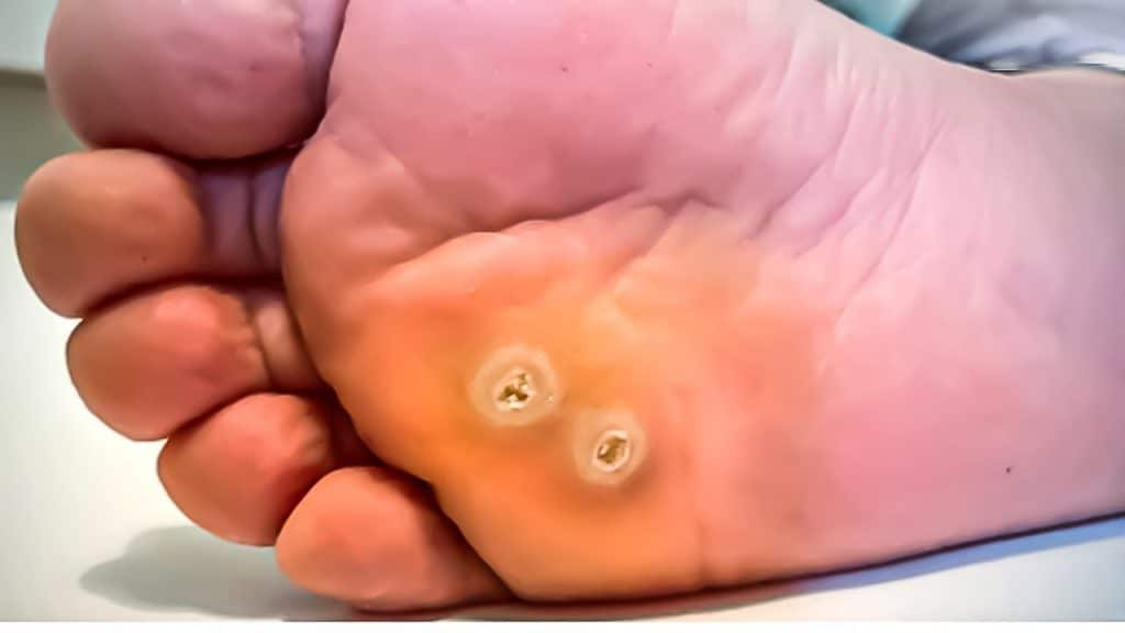 foot psoriasis