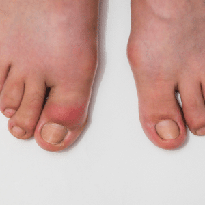 foot gout pain