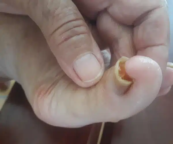 black toenail falling off causes