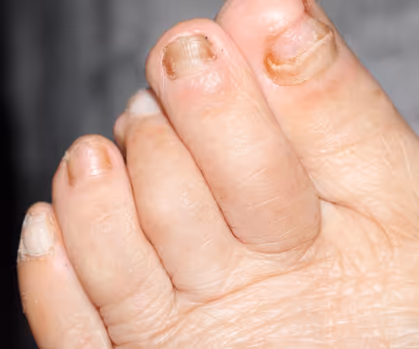 black toenail falling off treatment