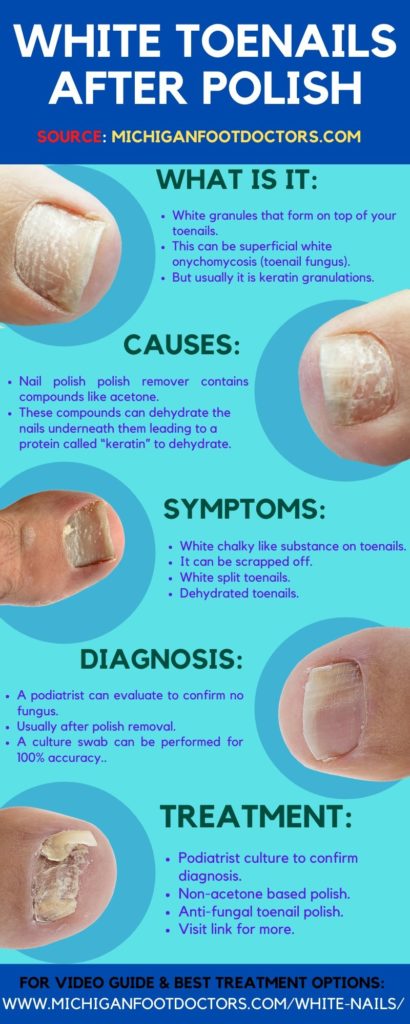 white spots on nail, white toenails after removing polish