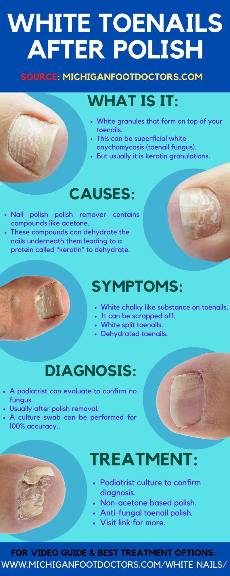 White Spots On Toenails [Causes, Home Remedies & Best Treatment]