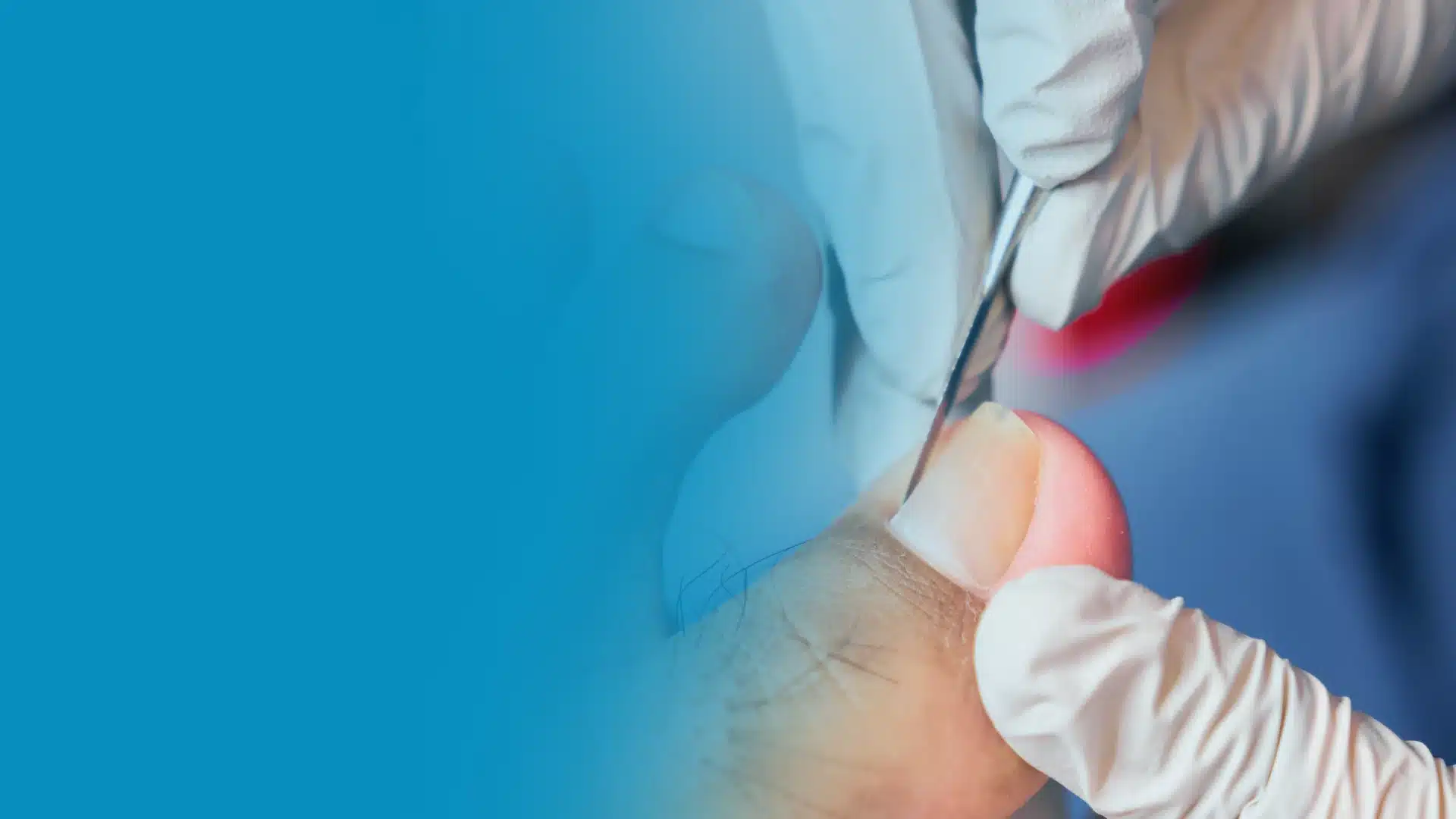 Pseudomonas Nail Infection treatment