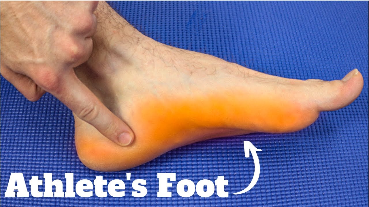 athletes foot fungus apple cider vinegar cure