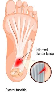 Bottom of the midfoot pain