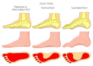 Flat foot pain flat feet